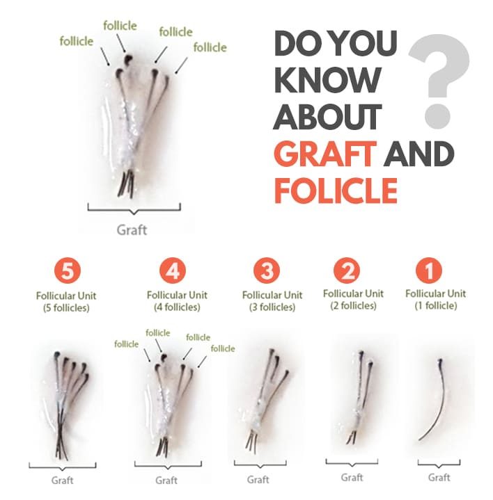 Hair Plugs vs Hair Implants follicle chart