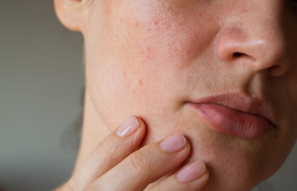 What is the best way to take care of dry skin?